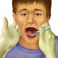 Angina faringotonzilitas.jpg